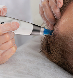 Dermapen 4 з екзосомами для шкіри голови