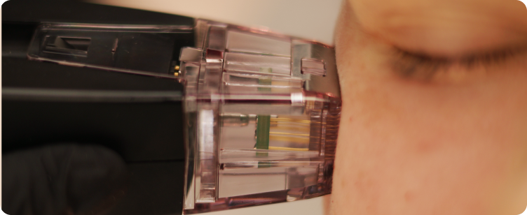 Мікроголковий RF MORPHEUS8